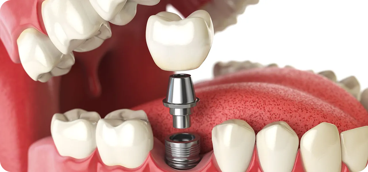 インプラント