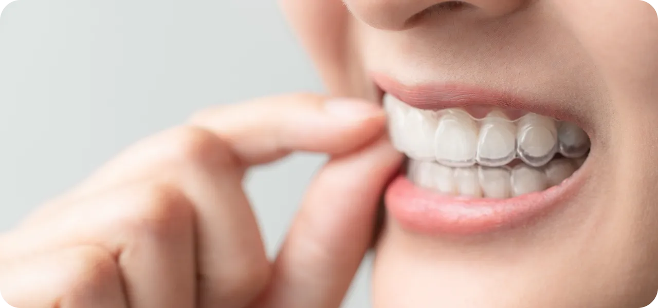 マウスピース矯正